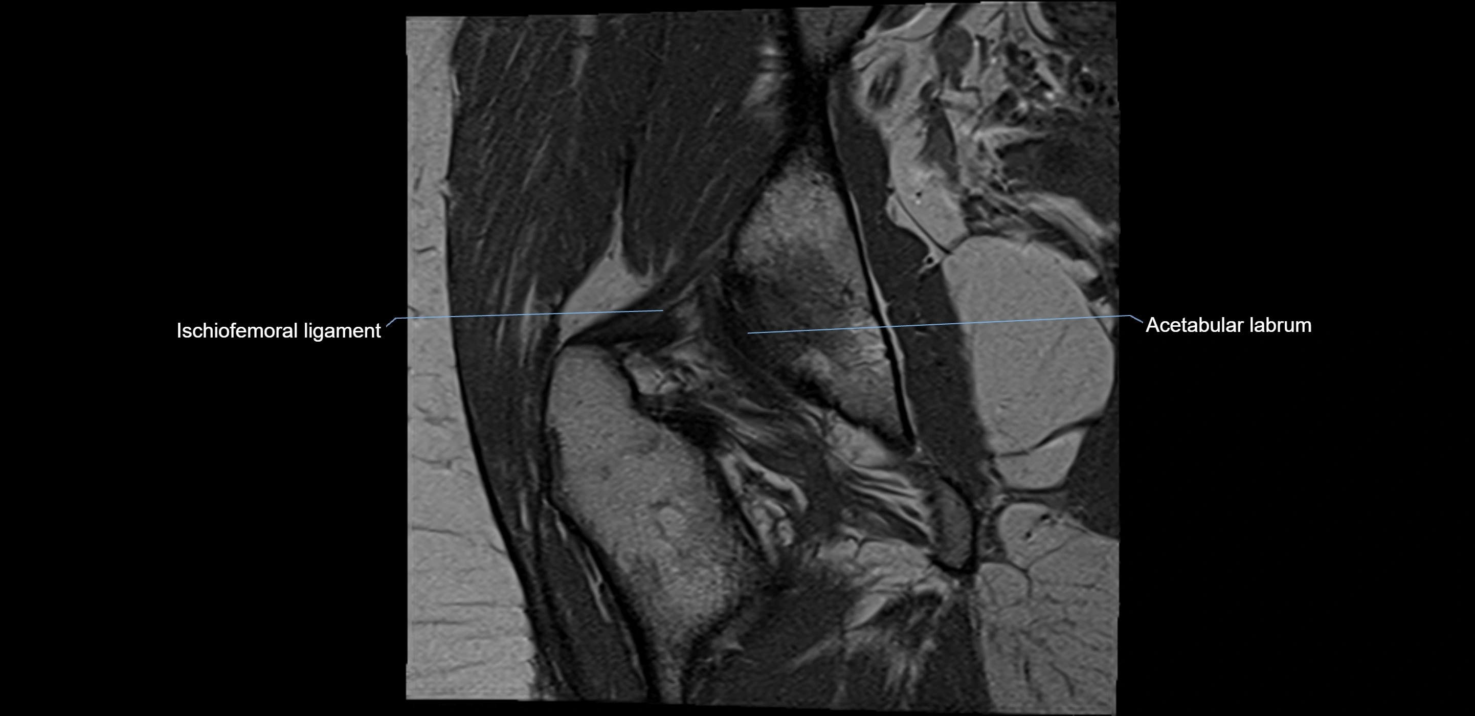 MRI Hip ligaments coronal cross sectional anatomy 3T  radiology  image-img-00001-00019.webp